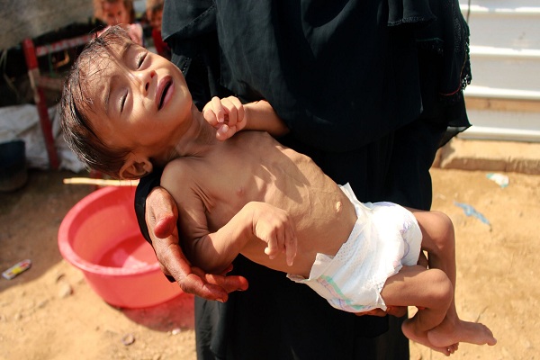 ‘It’s the Worst Place on Earth’: UN Food Agency Chief Says of Yemen  
