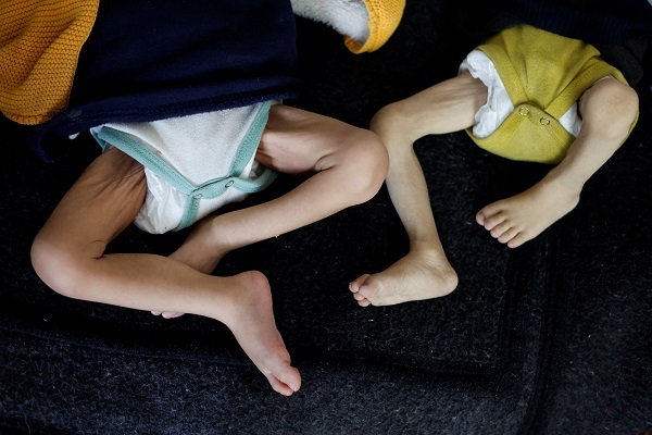 Over 50 Children Starving in Northern Gaza Amid Israeli Siege