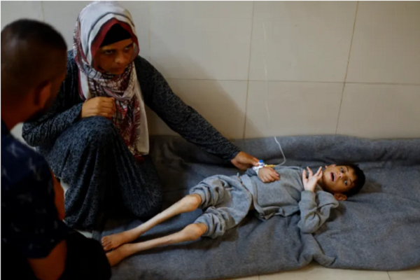 Most children in the Gaza Strip suffer from malnutrition as a result of the Israeli regime’s war and siege