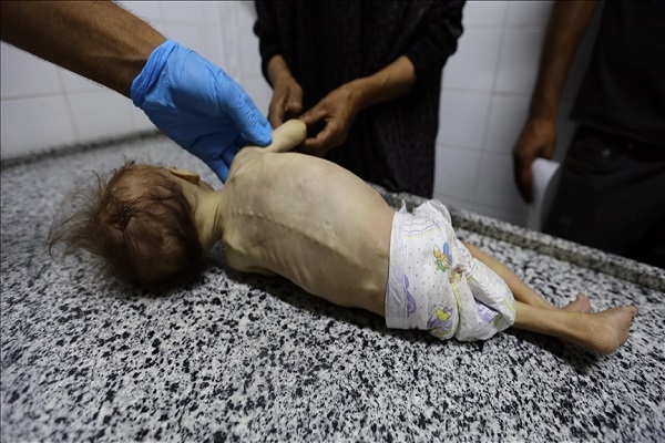 A Palestinian child suffering from malnutrition in Gaza