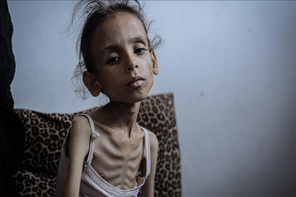 A child suffering from malnutrition as the Israeli siege of Gaza continues.