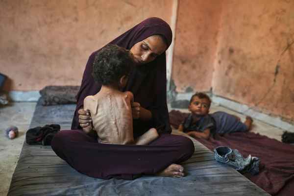 Most children in Gaza are suffering from malnutrition as a result of Israeli siege and war